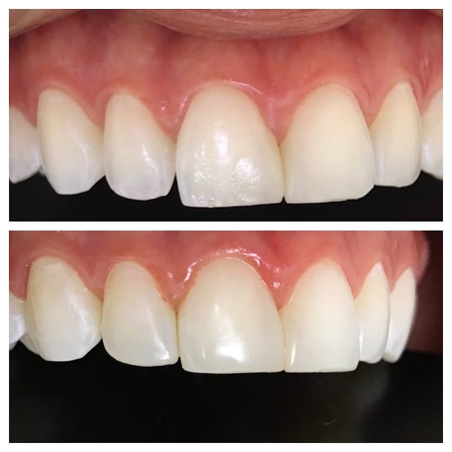 Antes e depois de um tratamento dental mostrando a saúde dos dentes.