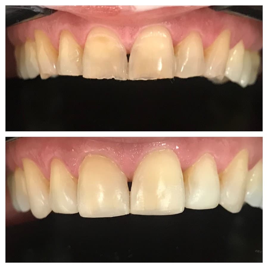 Antes e depois do tratamento dental com foco nos dentes.